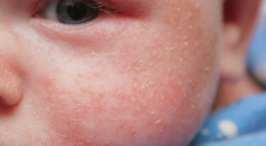 醫學界更新建議 鼓勵兒童更早進食花生 - JAN 5, 2017 (BC)