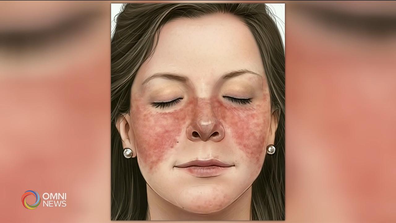 私人議案訂立紅斑狼瘡警覺日 -- May 09, 2019 (ON)