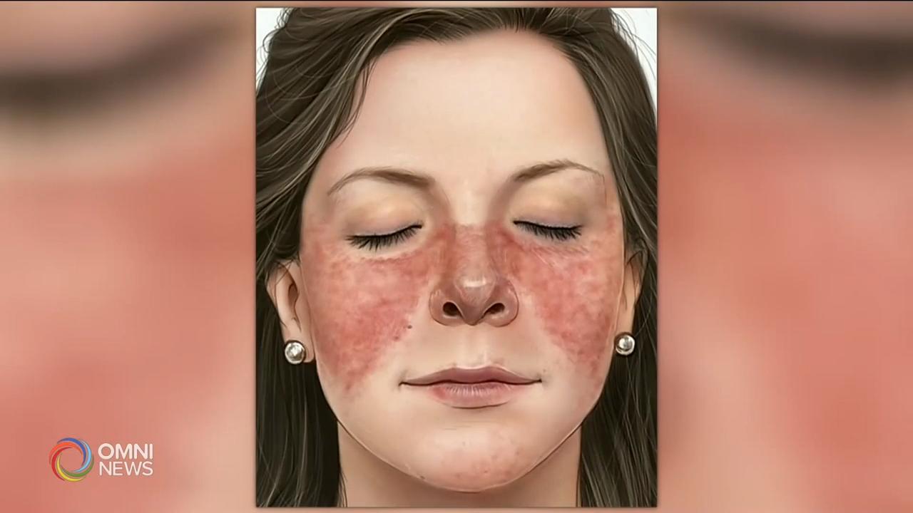 省议员彭锦威提案设立安省红斑狼疮关注日 – May 09, 2019 (ON)