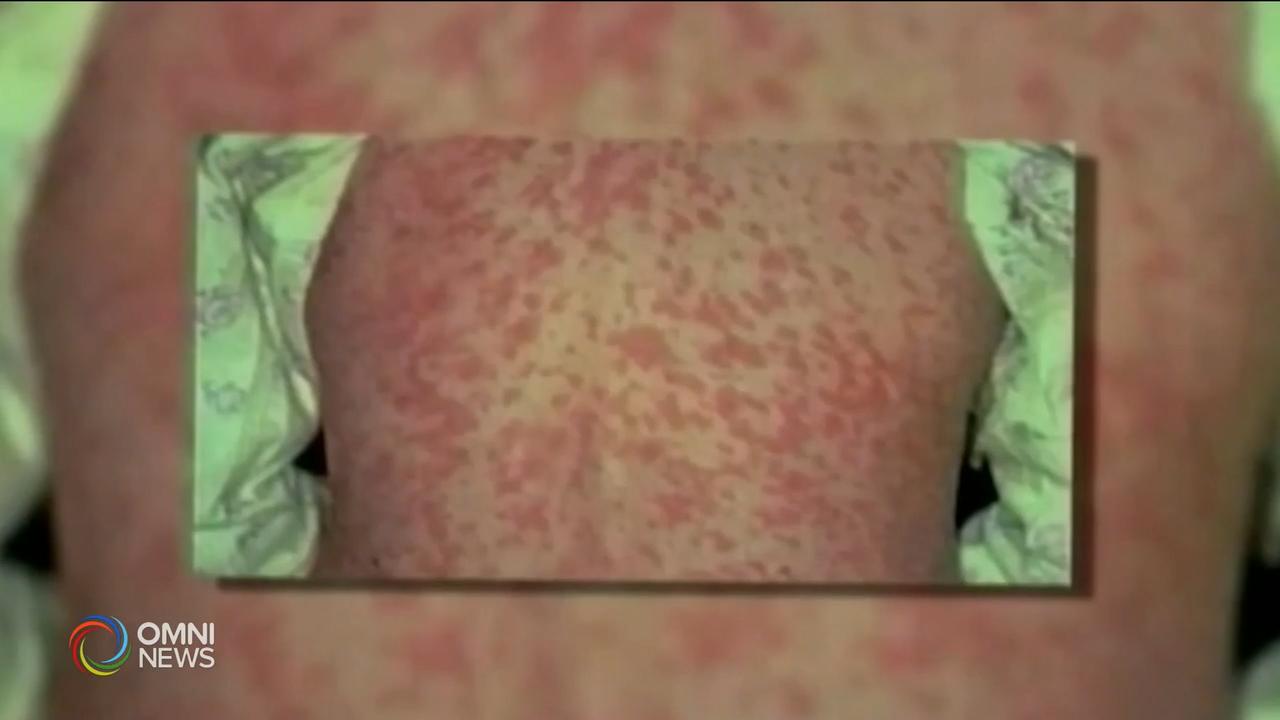 多倫多再確診兩宗外地感染麻疹個案 -- May 13, 2019 (ON)